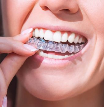 Alineadores Invisibles: La Revolución en Ortodoncia