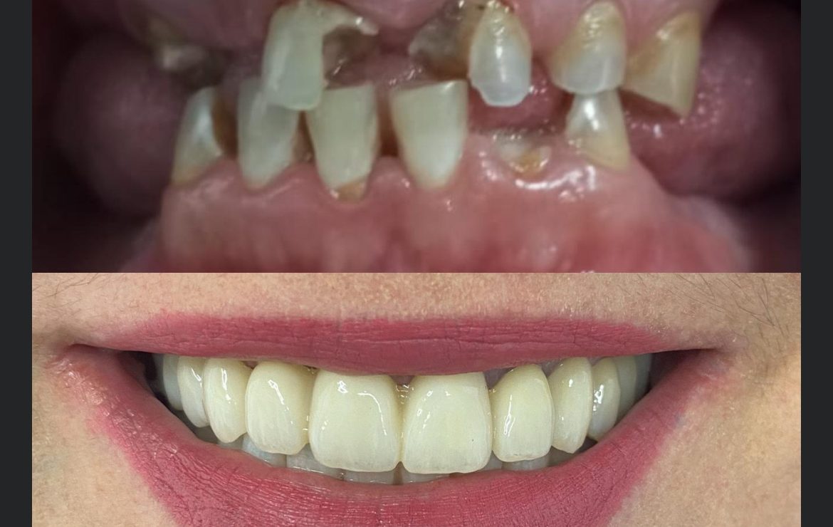 Implantes en 24/48h: Nuestra carga inmediata.