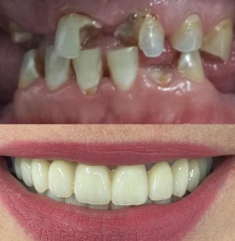 Implantes en 24/48h: Nuestra carga inmediata.