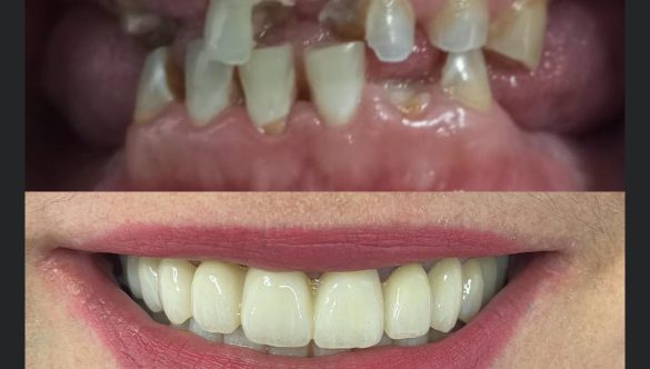 Implantes en 24/48h: Nuestra carga inmediata.