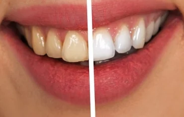 Estética Dental