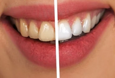 Estética Dental