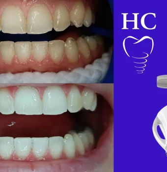 ¿Cuántos Tonos de Blanco Puedo Ganar con un Blanqueamiento Dental ?