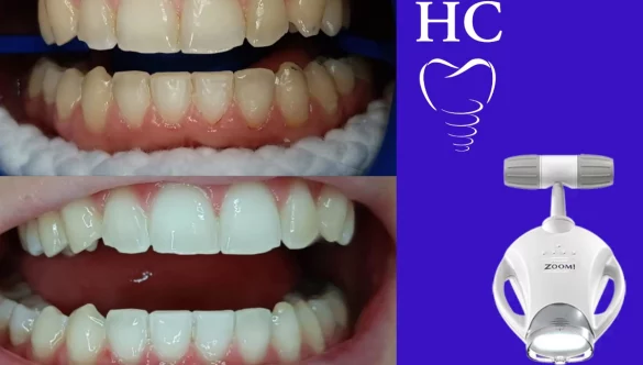 ¿Cuántos Tonos de Blanco Puedo Ganar con un Blanqueamiento Dental ?