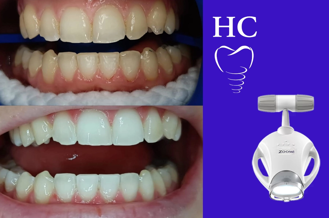 ¿Cuántos Tonos de Blanco Puedo Ganar con un Blanqueamiento Dental ?