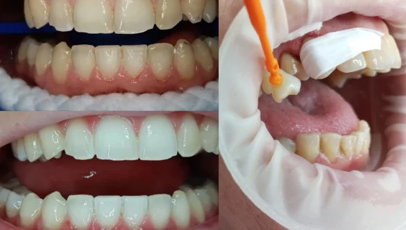 Novedades en Estética Dental: Mejorando tu Sonrisa en Clínica Dental Hugo Conza