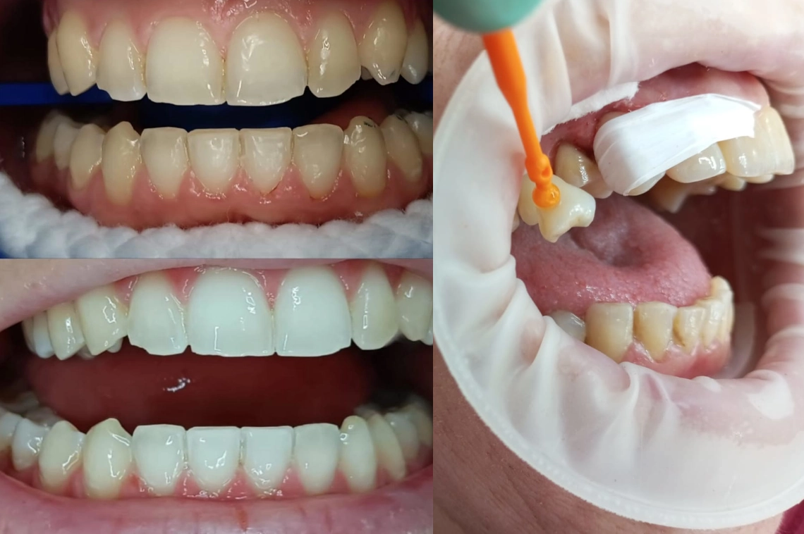Novedades en Estética Dental: Mejorando tu Sonrisa en Clínica Dental Hugo Conza