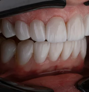 Salud de las Encías: ¿Por qué Sangran y Cuándo Deberías Realizarte un Chequeo Dental?