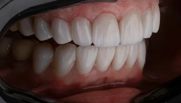 Salud de las Encías: ¿Por qué Sangran y Cuándo Deberías Realizarte un Chequeo Dental?