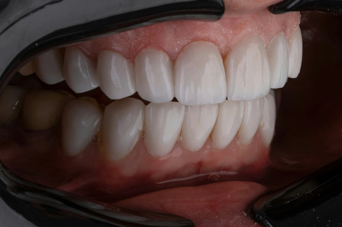 Salud de las Encías: ¿Por qué Sangran y Cuándo Deberías Realizarte un Chequeo Dental?