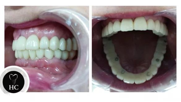 Implantes Dentales: ¿Son Realmente Para Siempre?