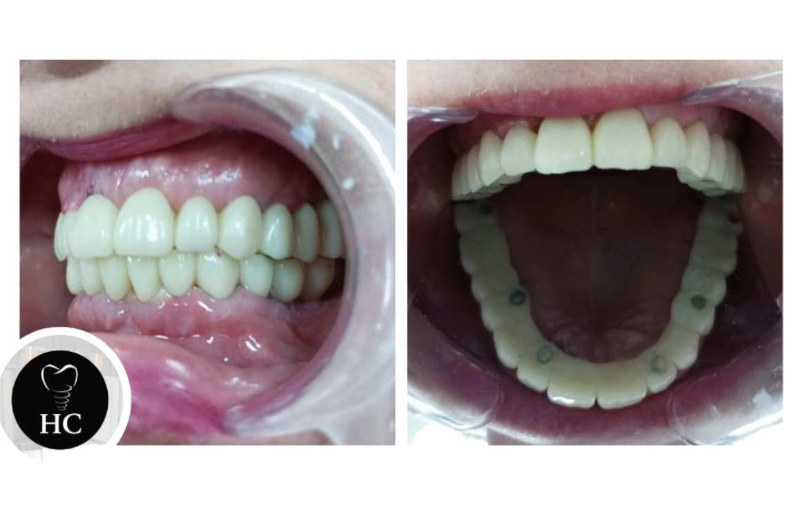 Implantes Dentales: ¿Son Realmente Para Siempre?