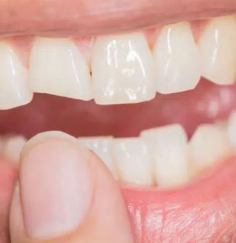 ¿Qué hacer en caso de sufrir un trauma dental?