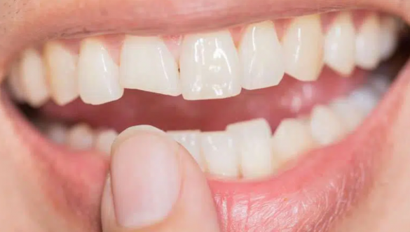 ¿Qué hacer en caso de sufrir un trauma dental?