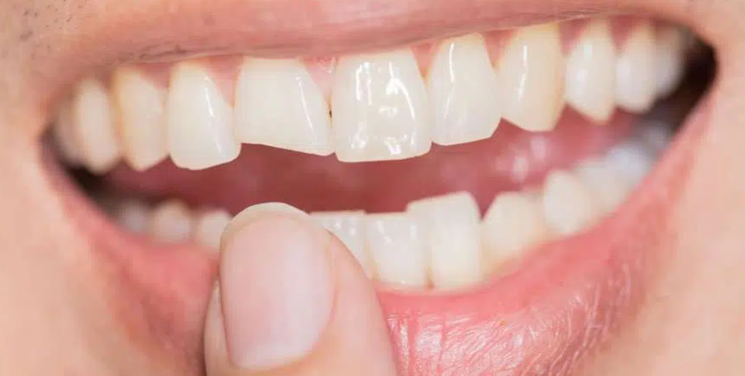 ¿Qué hacer en caso de sufrir un trauma dental?