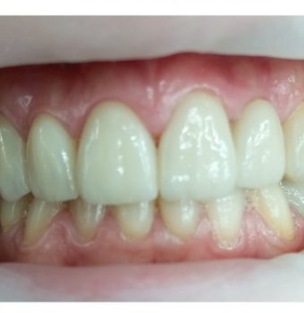 Carillas Onlays de Circonio: La Solución Perfecta para tu Sonrisa