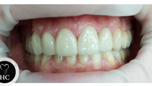 Carillas Onlays de Circonio: La Solución Perfecta para tu Sonrisa