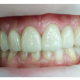 Carillas Onlays de Circonio: La Solución Perfecta para tu Sonrisa