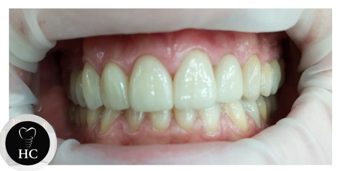 Carillas Onlays de Circonio: La Solución Perfecta para tu Sonrisa