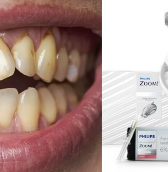 Manchas en los Dientes: Causas y Soluciones