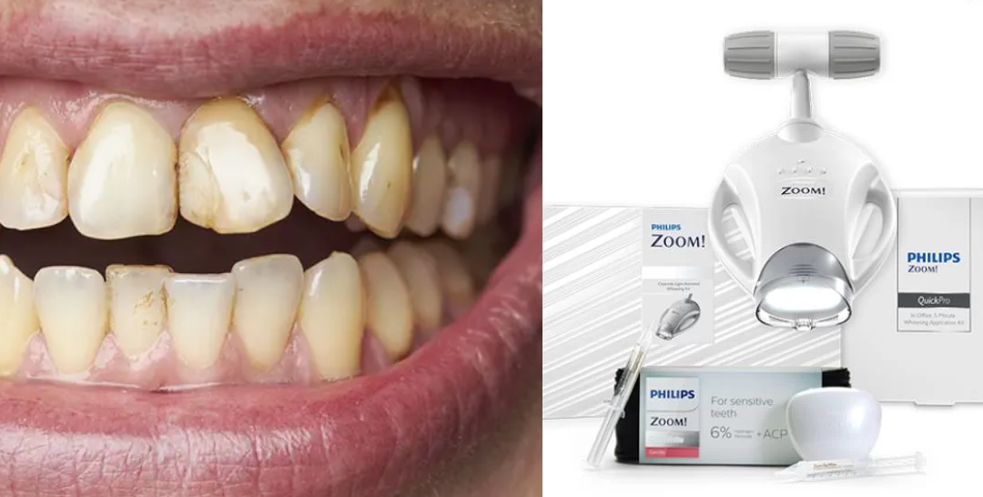 Manchas en los Dientes: Causas y Soluciones
