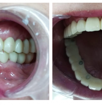 Implantes y Puentes Dentales: Soluciones para Recuperar tu Sonrisa
