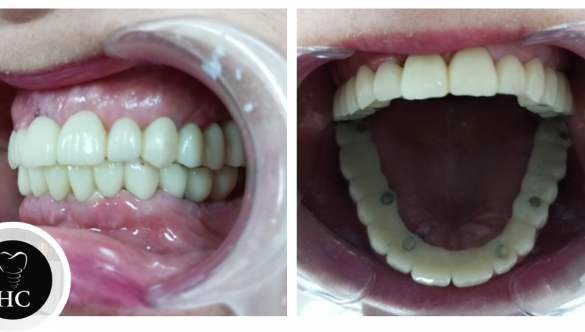 Implantes y Puentes Dentales: Soluciones para Recuperar tu Sonrisa