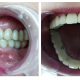 Implantes y Puentes Dentales: Soluciones para Recuperar tu Sonrisa