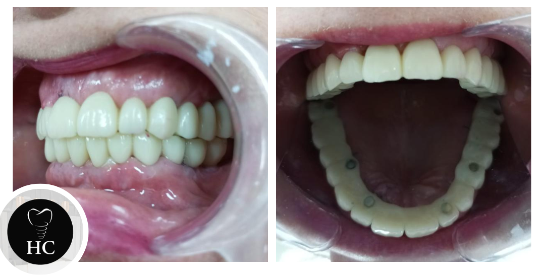 Implantes y Puentes Dentales: Soluciones para Recuperar tu Sonrisa