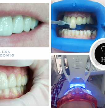 Estética Dental: Los Tratamientos Más Solicitados