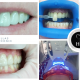 Estética Dental: Los Tratamientos Más Solicitados