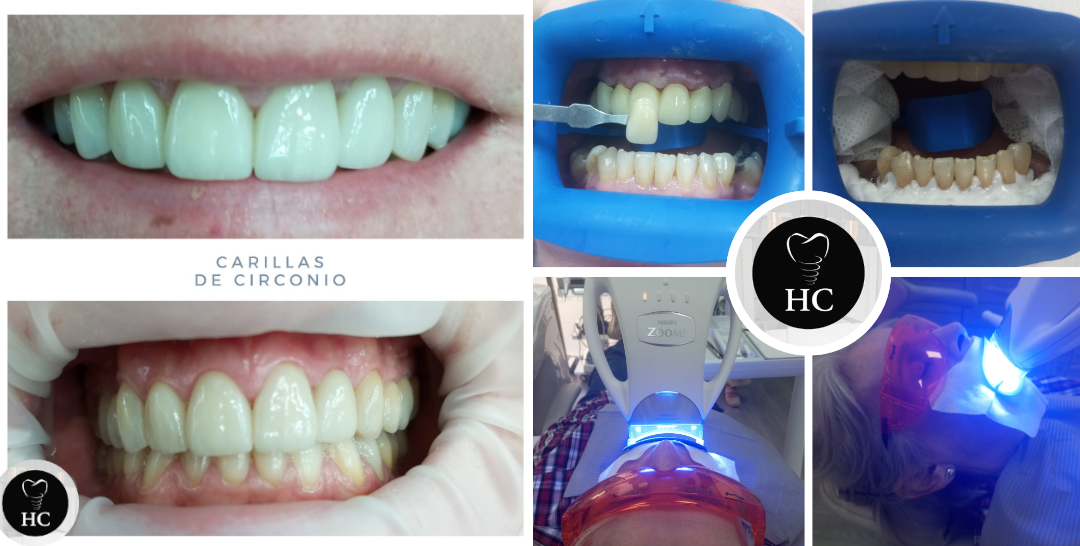 Estética Dental: Los Tratamientos Más Solicitados
