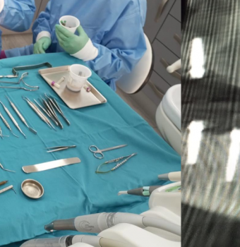 Alergia a los Materiales Dentales: Precauciones en Cirugías