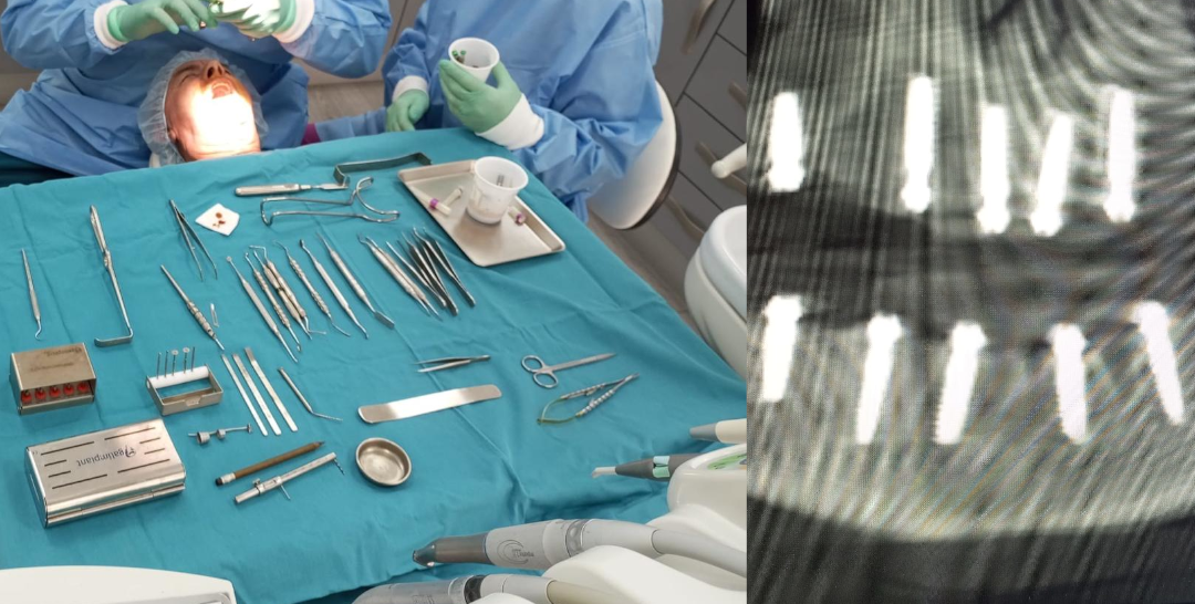 Alergia a los Materiales Dentales: Precauciones en Cirugías
