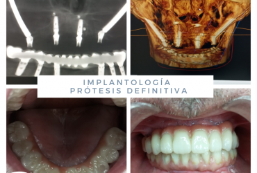 Prótesis definitiva