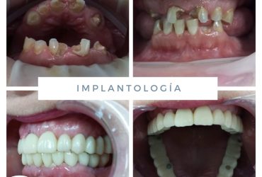 Implantología