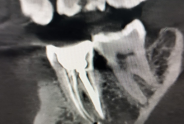 Endodoncia2