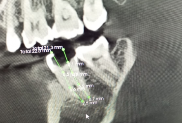 Endodoncia3