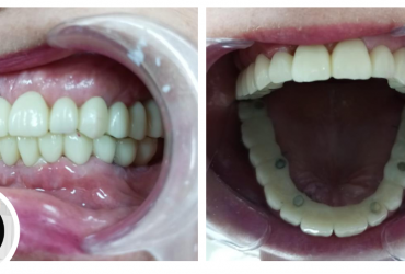 Implantes