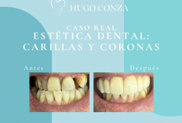 Carillas y coronas