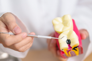 Causas de las caries: Por qué aparecen y cómo prevenirlas