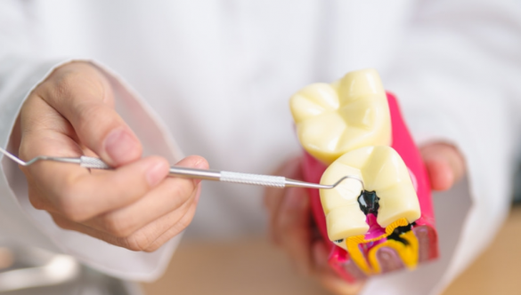 Causas de las caries: Por qué aparecen y cómo prevenirlas