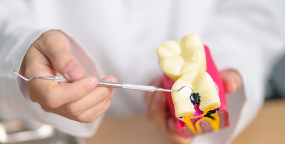 Causas de las caries: Por qué aparecen y cómo prevenirlas