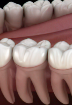 Muela del juicio: Cuándo debe extraerse y qué síntomas indican problemas