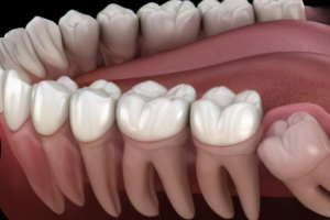 Muela del juicio: Cuándo debe extraerse y qué síntomas indican problemas