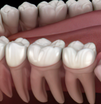 Muela del juicio: Cuándo debe extraerse y qué síntomas indican problemas