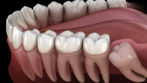 Muela del juicio: Cuándo debe extraerse y qué síntomas indican problemas