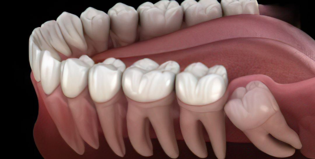 Muela del juicio: Cuándo debe extraerse y qué síntomas indican problemas