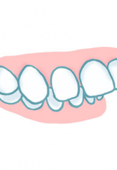 Sobremordida: Qué es, por qué aparece y cómo se corrige