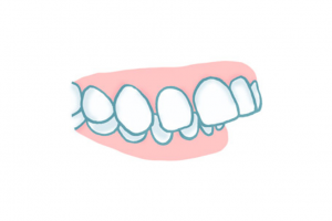 Sobremordida: Qué es, por qué aparece y cómo se corrige